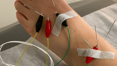 Image for Short Acupuncture  Subsequent Visit 30 min