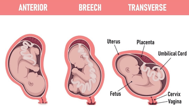 Image for Breech baby